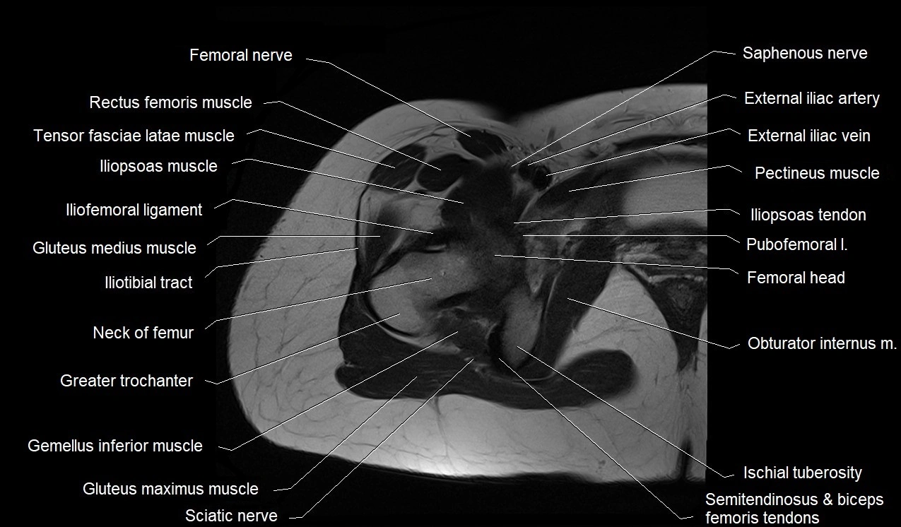 MRI thigh cross sectional anatomy image 9.webp